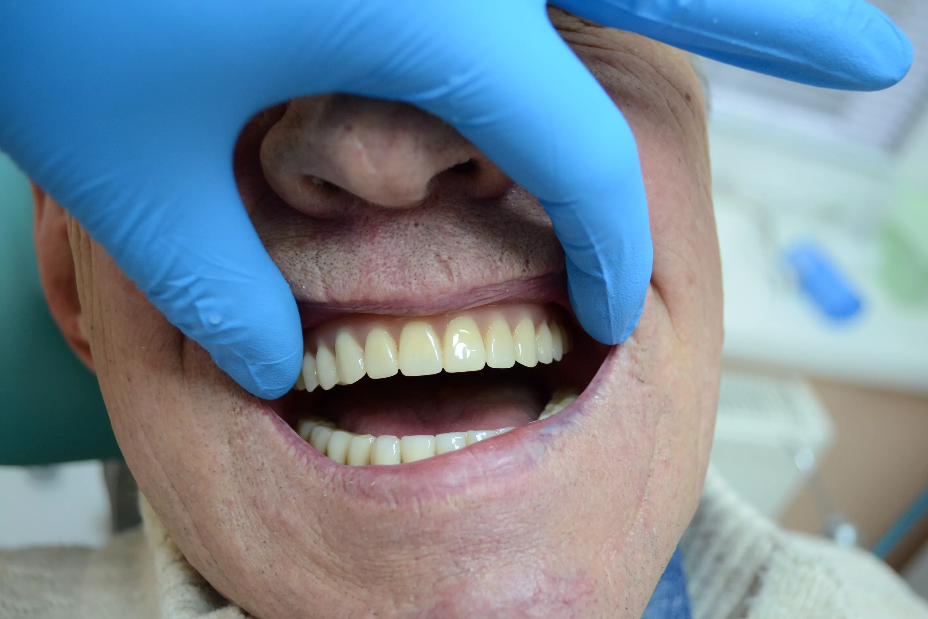 Read more about the article Протезирование при полной потере зубов: варианты и цены