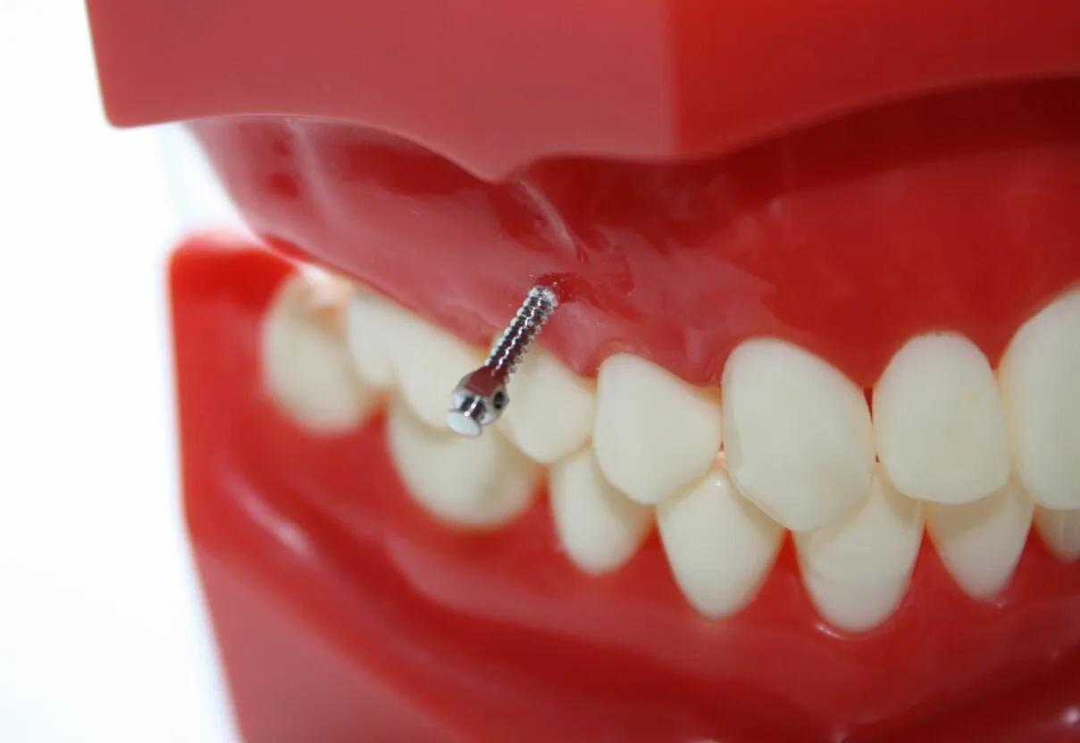 Read more about the article Что такое ортодонтический мини-винт (TAD) и зачем он нужен